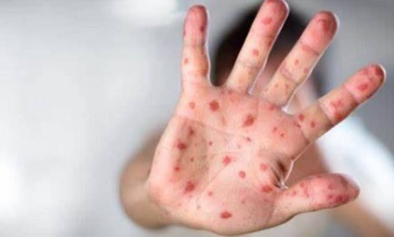 تكساس تسجل تسع حالات حصبة جديدة وارتفاع الاجمالي الى سبعمئة وثمانية وثلاثين